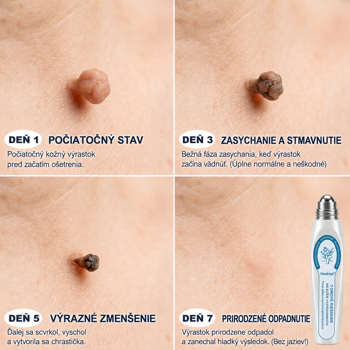 💌Healrize® Eliminator de Marcas y Manchas en 𝟳 Dias (Sin Dolor, Sin Cicatrices con Applicador Rollerball)📌6
