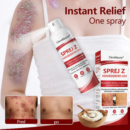 🔴Healrize® Beef Tallow Spray na svrbiacu, olupujúcu pokožku pri psoriáze