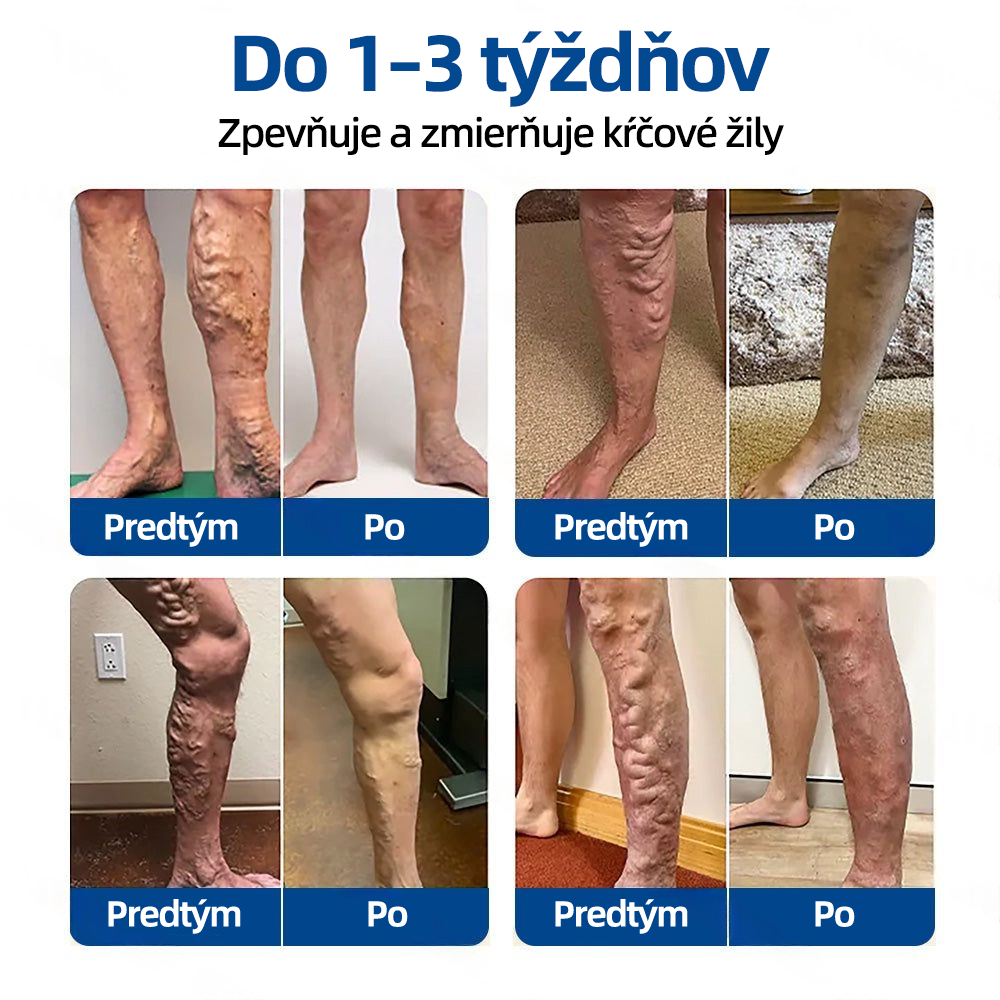 Healrize® VeinTarget Microneedle Patch  Okamžitá úľava, dlhodobé výsledky 🏃‍♂️‍➡️🏃‍♂️‍➡️3