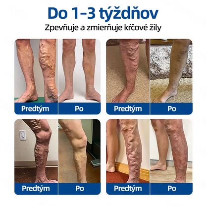 Healrize® VeinTarget Microneedle Patch  Okamžitá úľava, dlhodobé výsledky 🏃‍♂️‍➡️🏃‍♂️‍➡️3