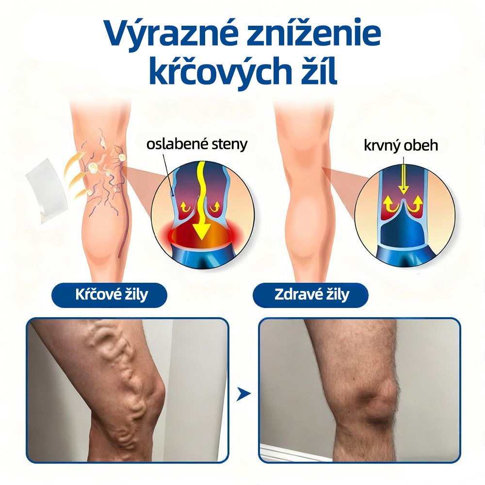 Healrize® VeinTarget Microneedle Patch  Okamžitá úľava, dlhodobé výsledky 🏃‍♂️‍➡️🏃‍♂️‍➡️3