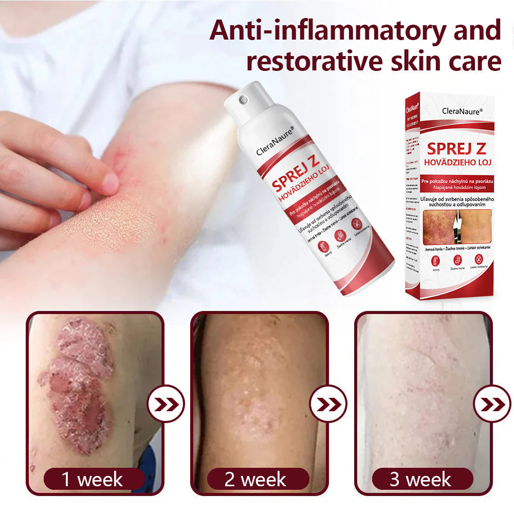🔴Healrize® Beef Tallow Spray na svrbiacu, olupujúcu pokožku pri psoriáze