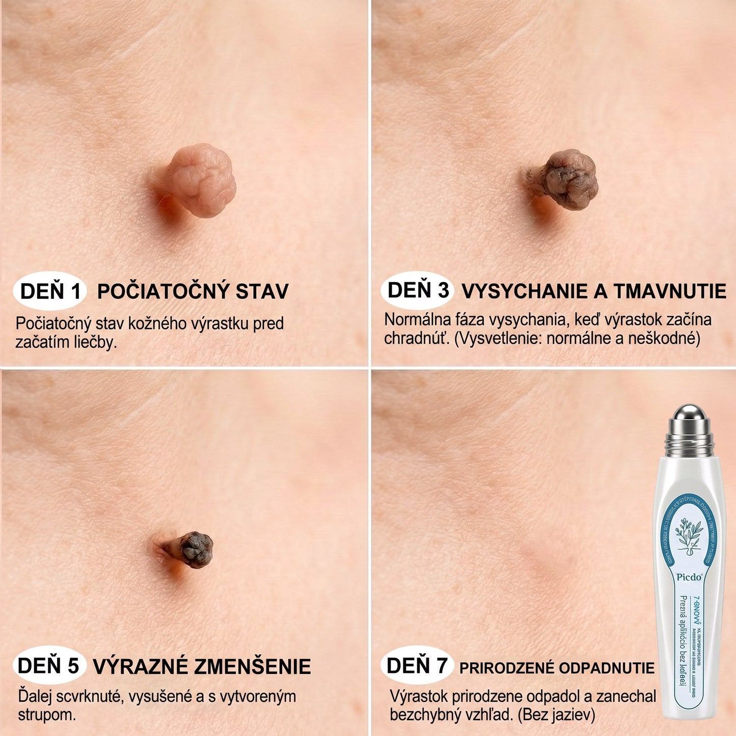 𝐇𝐞𝐚𝐥𝐫𝐢𝐳𝐞® 👩‍⚕️🍉 7-𝑫ň𝒐𝒗ý 𝑵𝒂 𝑶𝒅𝒔𝒕𝒓𝒂ň𝒐𝒗𝒂𝒏𝒊𝒆 𝑷𝒊𝒈𝒎𝒆𝒏𝒕𝒐𝒗ý𝒄𝒉 Š𝒌𝒗ŕ𝒏 𝑨 𝑱𝒂𝒛𝒊𝒆𝒗 𝑷𝒆𝒓𝒐(𝐵𝑒𝑧 𝑏𝑜𝑙𝑒𝑠𝑡𝑖, 𝑏𝑒𝑧 𝑗𝑎𝑧𝑖𝑒𝑣 – 𝑟𝑜𝑙𝑙𝑒𝑟𝑏𝑎𝑙𝑙)📌📌